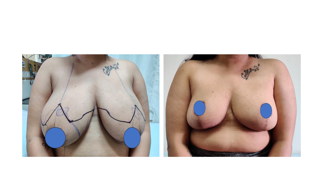 Breast Reconstruction Photo 8
